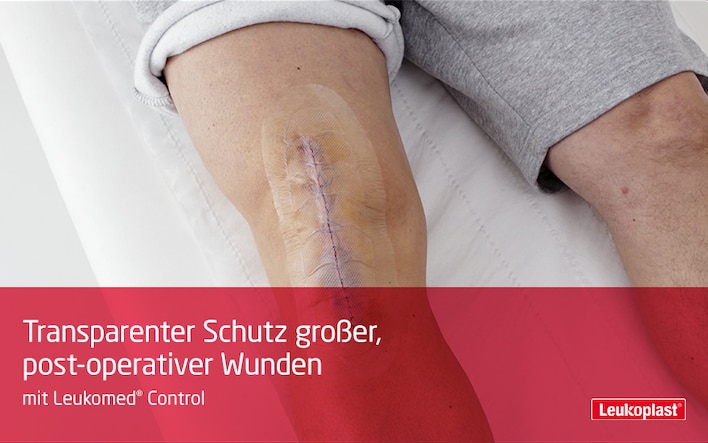 In diesem Video wird gezeigt, wie post-operative Wunden mit Leukomed Control behandelt werden: Zu sehen sind die Hände einer medizinischen Fachkraft, die eine chirurgische Inzision auf dem Knie eines Patienten bedeckt.