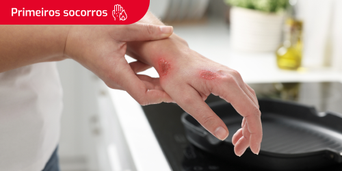 Pessoa na cozinha com uma queimadura na mão e o texto "Primeiros socorros" numa caixa no canto superior esquerdo.