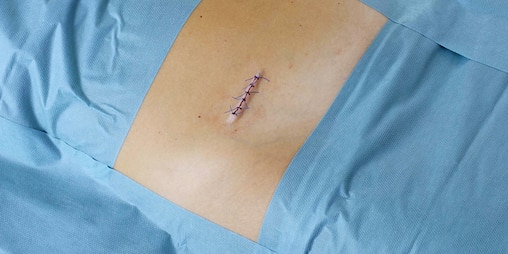 Protezione di incisioni chirurgiche con Leukomed® Control