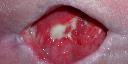 Dekubitus optimal versorgen