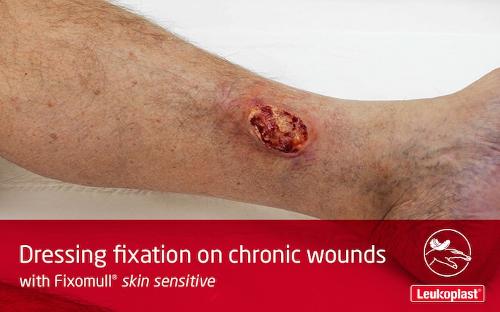 Tässä videossa opitaan käyttämään Fixomull skin sensitiveä jalkojen haavaumien hoitoon: videolla näytetään terveydenhuollon ammattilaisen kädet, jotka kiinnittävät suuren sidoksen potilaan säären haavauman päälle.