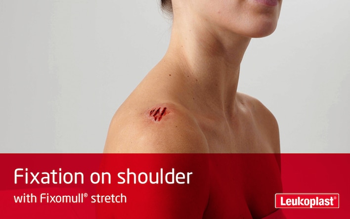 In this video we learn how Fixomull stretch is used for abrasion treatment. We see the hands of an HCP cutting to size and applying a large dressing to the abrasion on a woman patient's shoulder.