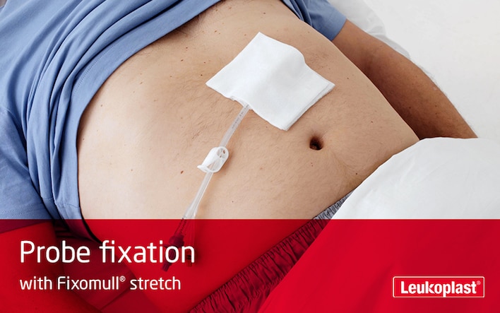 This video shows how to secure a probe with the help of Fixomull stretch medical tape: We see the hands of an HCP attaching a probe to a patient's abdomen.
