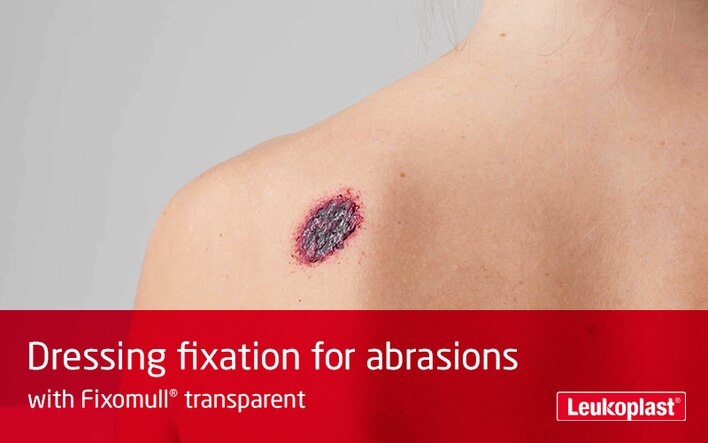 In this video is shown how Fixomull transparent can be used used for abrasion treatment. We see the hands of an HCP cutting to size and applying a dressing to the abrasion on a woman patient's shoulder.