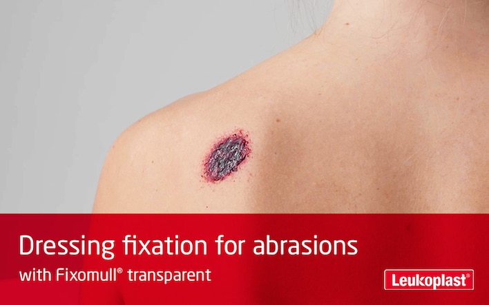 In this video is shown how Fixomull transparent can be used used for abrasion treatment. We see the hands of an HCP cutting to size and applying a dressing to the abrasion on a woman patient's shoulder.