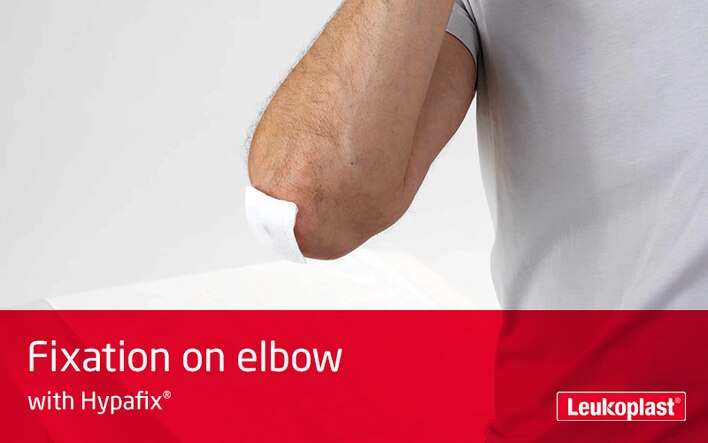 I denne videoen skal vi lære hvordan Hypafix stretch medisinsk tape benyttes til å feste bandasje på et ledd: Vi ser en helsearbeiders hender som setter bandasje på albuen til en mannlig pasient.
