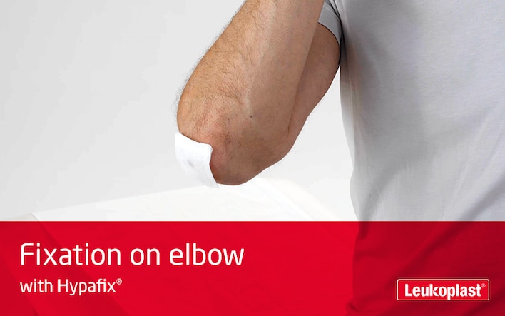 Tällä videolla näytetään, kuinka Hypafix -elastista teippiä käytetään sidoksen kiinnittämiseen niveleen: videolla näkyy terveydenhuollon ammattilaisen kädet, jotka asettavat sidoksen miespotilaan kyynärpäähän.