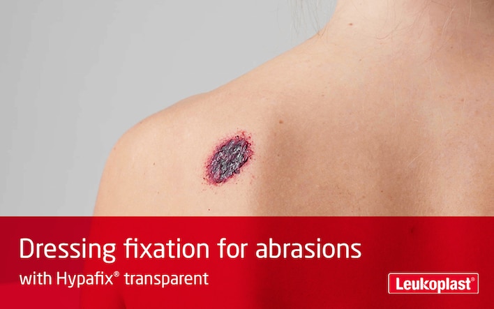 In this video is shown how Hypafix transparent can be used used for abrasion treatment. We see the hands of an HCP cutting to size and applying a dressing to the abrasion on a woman patient's shoulder.