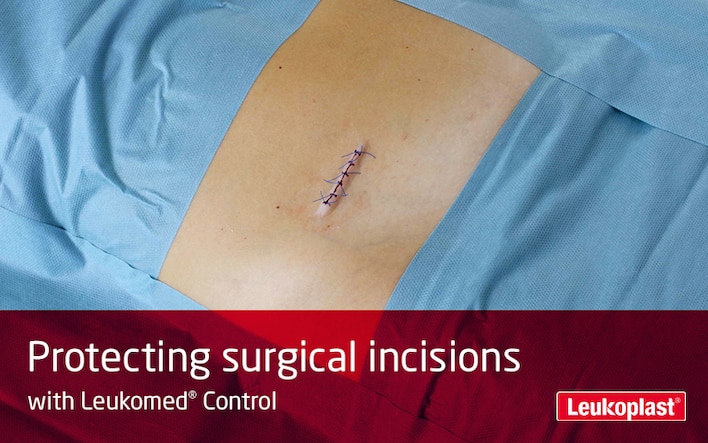 Dette videoklippet viser hvordan å beskytte kirurgiske sår under helingsprosessen:  Vi ser en helsearbeiders hender dekke et kirurgisk snitt med Leukomed Control.