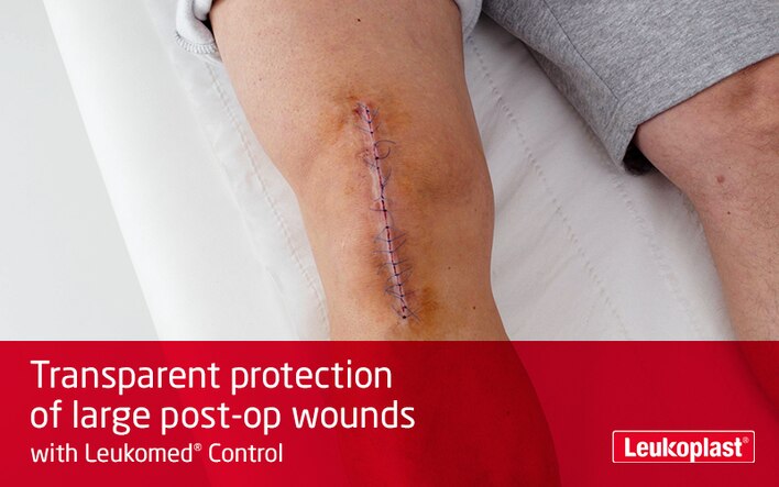 Videon visar hur man tar hand om postoperativa sår med Leukomed Control: Vi ser vårdpersonalens händer som täcker ett kirurgiskt snitt på en manlig patients knä.