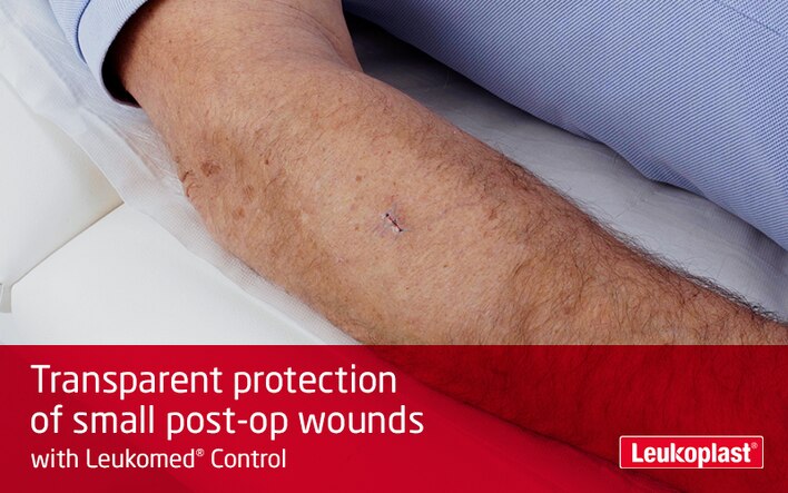 Filmen visar hur ett transparent sårförband används: vi ser vårdpersonalens händer som täcker ett kirurgiskt snitt på en patients underarm med Leukomed Control. 