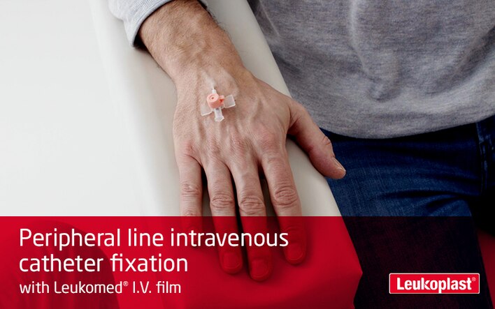 Denna film visar hur en intravenös infart säkras med ett I.V. förband: vi ser hur en vårdpersonal använder Leukoplast I.V. film på baksidan av patientens hand och säkrar en kateter.