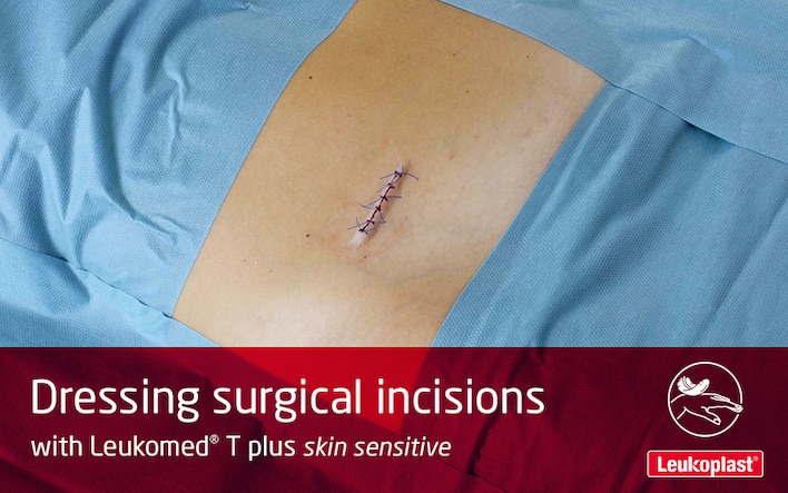 Denne video viser, hvordan man beskytter kirurgiske snit på sårbar hud med Leukomed T plus skin sensitive: Vi ser en sundhedspersons hænder, der dækker et sår efter en operation på en patients mave. 