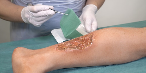 Obrázok zobrazujúci nohu s infikovanou chronickou ranou.