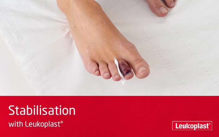 Deze film laat zien hoe tenen kunnen worden gestabiliseerd met kleefpleister: We zien in close-up hoe een zorgmedewerker de teen van een patiënt fixeert met daarnaast Leukoplast kleefpleister.