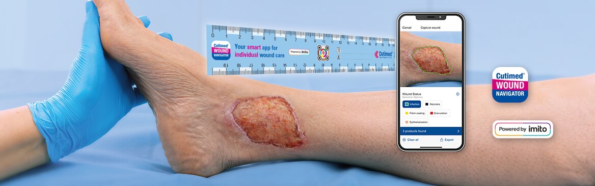 Image showing an infected wound measured by the Cutimed Wound Navigator app.