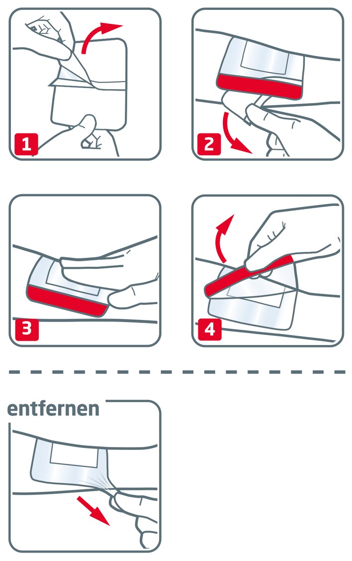 Anwendung von Leukomed T Plus