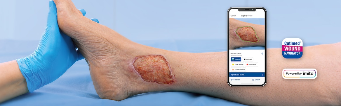 Bilde som viser et infisert sår målt med Cutimed Sårapp.