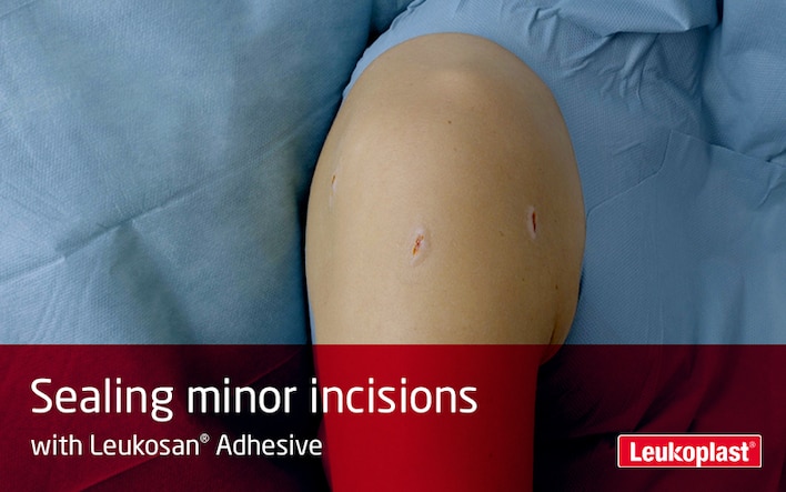 In this video, we see how small incisions or cut wounds can be sealed using Leukosan Adhesive. We see an HCP performing wound closure without stitches on a patient's shoulder.