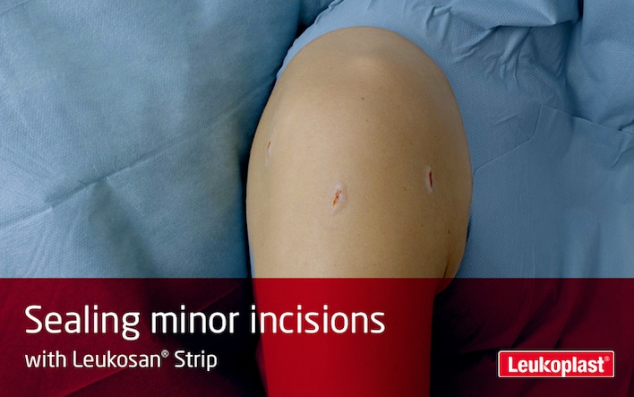 Here we can see in a close-up how minor incisions are treated using wound closure strips: we see an HCP sealing three small cut wounds on a patient's shoulder with the help of Leukosan Strip.