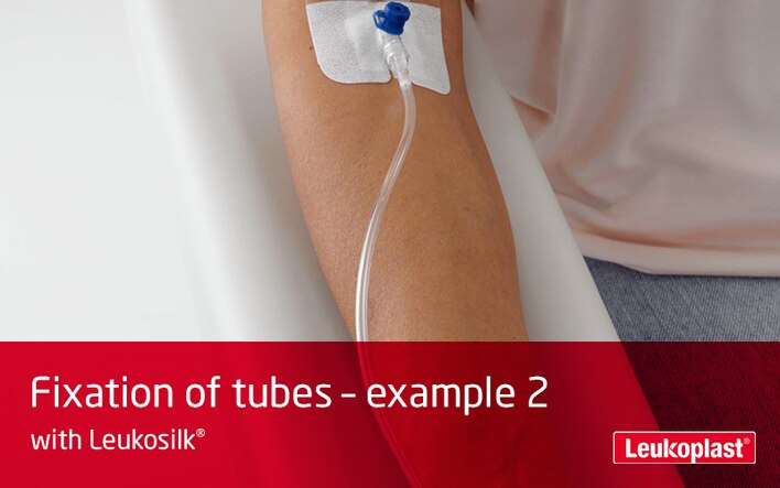 Deze video laat zien hoe buisjes worden vastgezet met kleefpleister voor de gevoelige huid: de handen van een zorgmedewerker bevestigen het buisje aan de onderarm van een patiënt met Leukosilk kleefpleister.