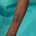 Skin infections and skin tone in wound healing | Leukoplast UK