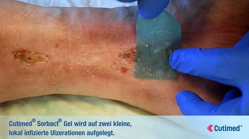 Cutimed Sorbact Gel - Anwendungsvideo