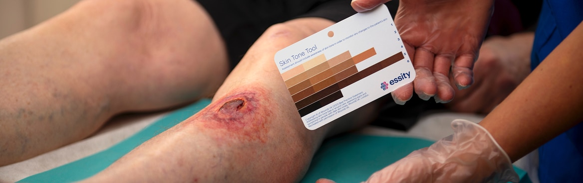 Leg wound on a patient's knee with a nurse holding a skin tone tool next to the skin