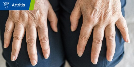 Manos con síntomas de artritis reumatoide. Se lee el texto “Artritis” en un recuadro. 