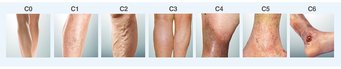 Tratamiento de úlceras venosas en las piernas, gestión holística de ...