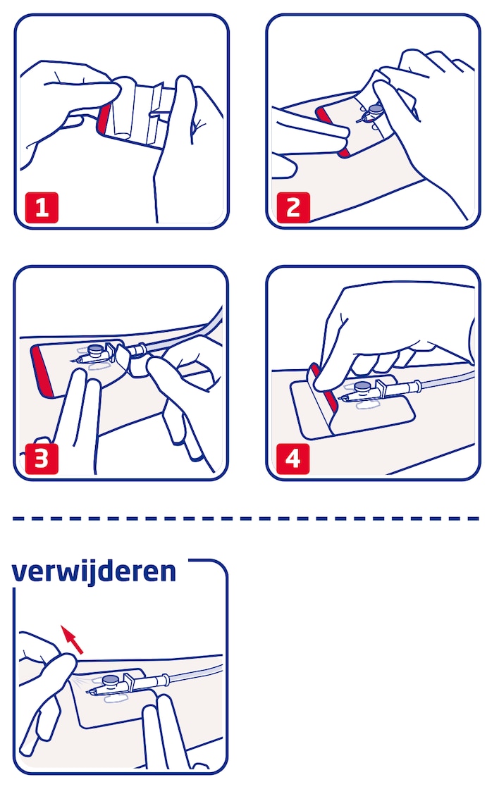 Hoe Leukomed IV film van Leukoplast gebruiken