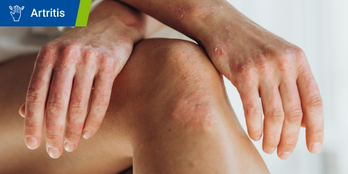 Mujer con síntomas visibles de artritis psoriásica en las manos y la rodilla. Se lee el texto “Artritis” dentro de un recuadro. 
