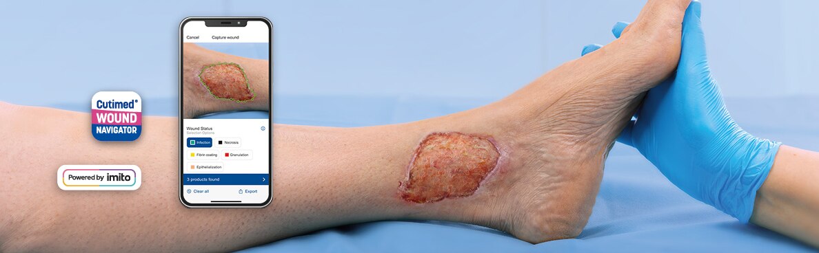 Imagen de un pie con una herida mientras que se usa CWN